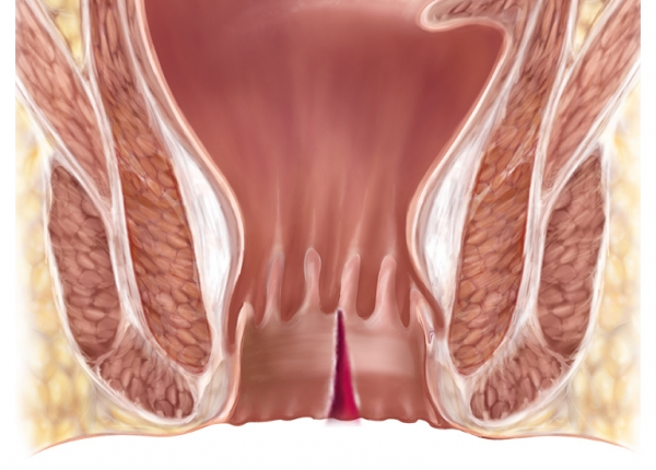 Fissure anale - NEMAUDIG